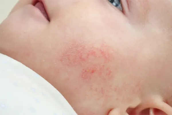 Twarz niemowlęcia z widoczną zmianą atopową na policzku